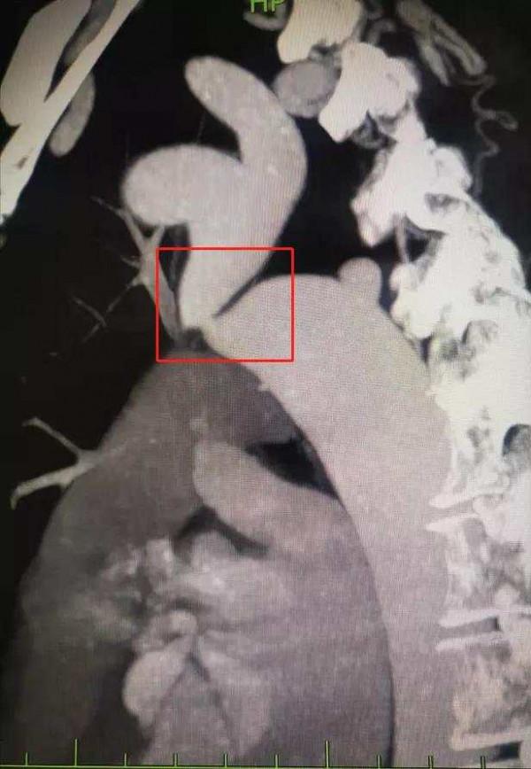 打疫苗意外發現自己的“超高血壓”，專家：這種病隱匿又危險