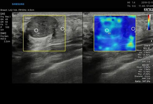 三星醫療高階超聲診斷系統&mdash;&mdash;RS85 Prestige
