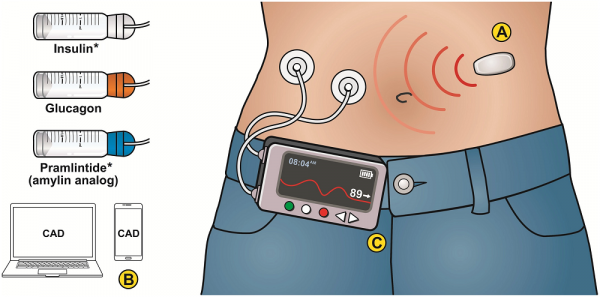 “人工胰腺”新進展：全面改善「老年1型糖尿病患者」血糖控制