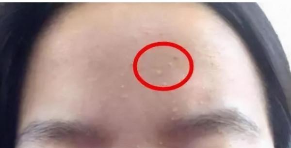 建議有“閉口”的女生，堅持做好這幾件事，高效解決不反覆