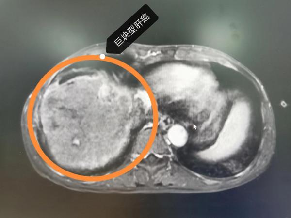 晚期肝癌的介入治療