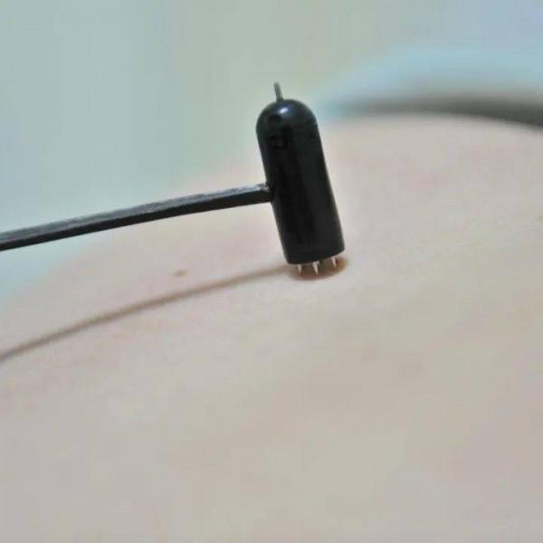 暗香療百病 巧用梅花針&mdash;&mdash;廣安門醫院梅花針專題門診