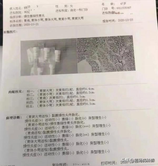 葉酸+摩羅丹,治療萎縮性胃炎伴腸化 葉酸+摩羅丹,治療萎縮性胃炎伴腸化