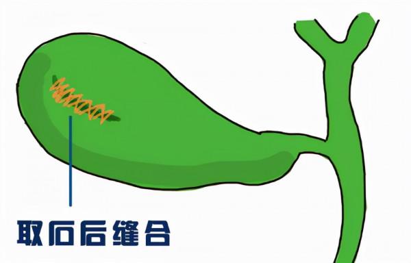 “冬季到，膽結石鬧”那麼治療膽結石到底是切還是保？