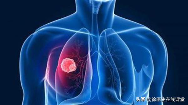 35歲女子雙腳水腫,診斷腎病綜合徵,出現咳嗽時醫生才發現是肺癌 35歲女子雙腳水腫,診斷腎病綜合徵,出現咳嗽時醫生才發現是肺癌