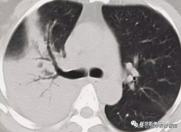 22個肺部疾病的CT徵象 22個肺部疾病的CT徵象