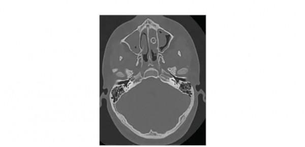 一場手術後，他的心臟長出了水泥 | 2021奇葩病例盤點
