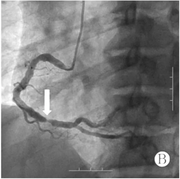 病例分享——前壁心肌梗死伴慢性腎臟病患者急診PCI中血運重建