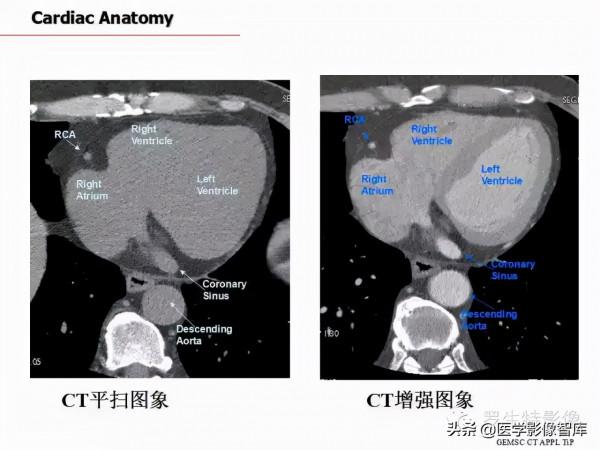 CT斷層解剖圖譜最全總結「推薦收藏」 CT斷層解剖圖譜最全總結「推薦收藏」