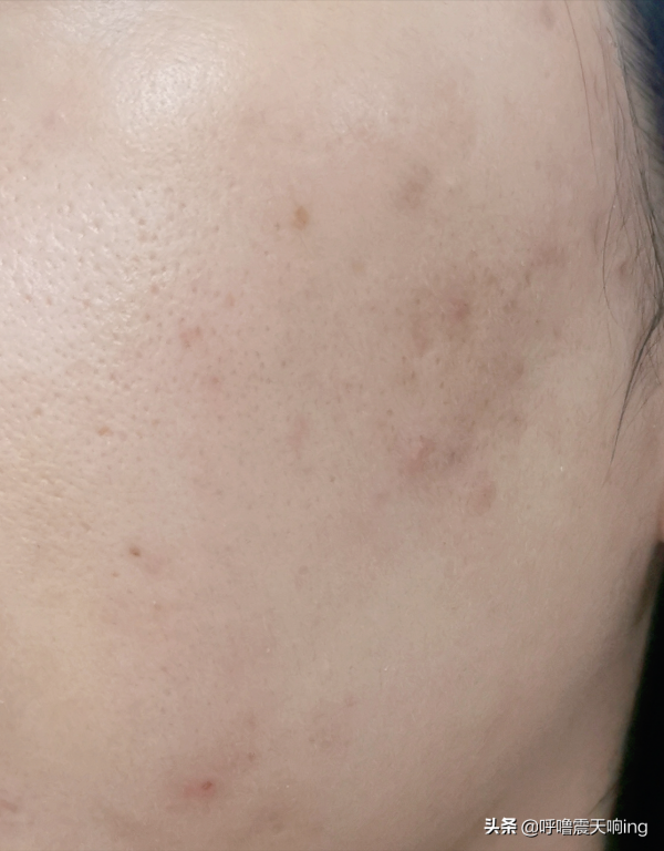 臉上長痘，好煩躁 2