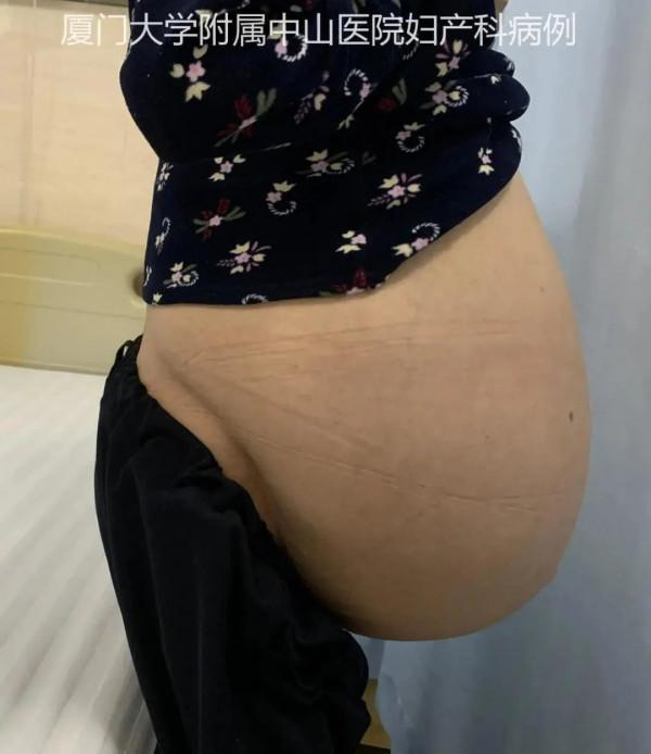 天啊!切除下的巨大腫瘤重達44斤!廈門大學附屬中山醫院成功完成 天啊!切除下的巨大腫瘤重達44斤!廈門大學附屬中山醫院成功完成