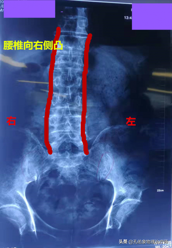 腰椎間盤突出，臀部疼痛、麻木，是怎麼回事？該如何治療