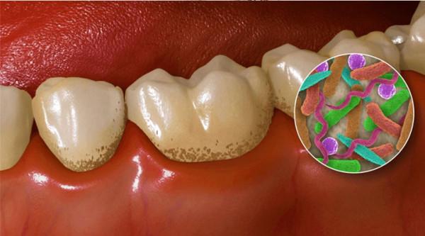 按時刷牙為什麼還需要口腔含漱液？