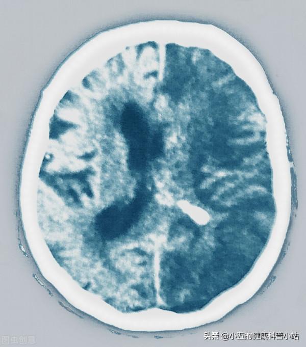 心房顫動患者日常生活如何保健？避免5個誘因，做好6個方面