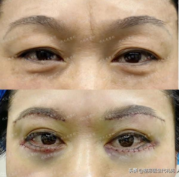 面部開始鬆弛下垂衰老的三大訊號，一定要開始注意了