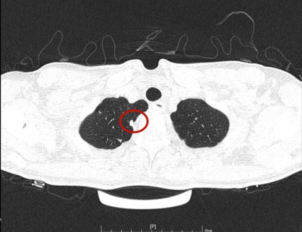 問診分析：兩肺多發實性結節，各科各醫院意見不一，如何是好？