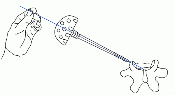 真的嗎?背上打個孔,十多年的腰腿痛就好了 真的嗎?背上打個孔,十多年的腰腿痛就好了