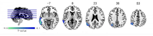腦科學日報:慢性頸痛不僅傷身而且傷腦 腦科學日報:慢性頸痛不僅傷身而且傷腦