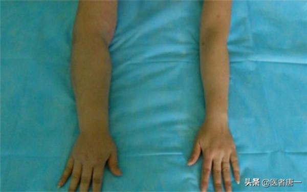 腎功能受損有哪些徵兆?提醒:除了泡沫尿,這5種症狀也別大意 腎功能受損有哪些徵兆?提醒:除了泡沫尿,這5種症狀也別大意