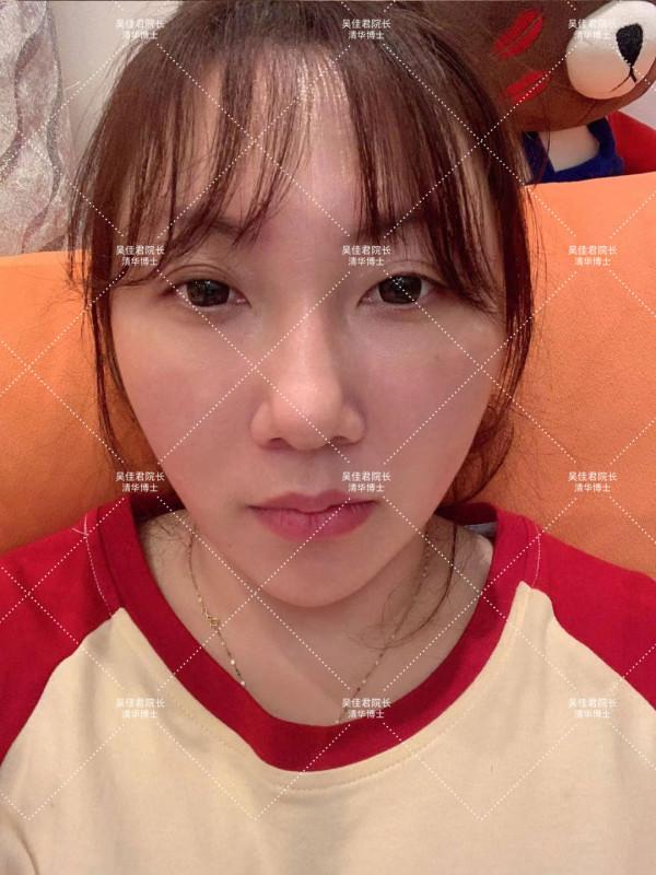 38歲小拉皮術後5個月,跟大家說一說我的經歷 38歲小拉皮術後5個月,跟大家說一說我的經歷