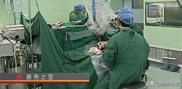 真實故事:山西45歲女子一夜變黑,體重急速增加,手術後讓家人落淚