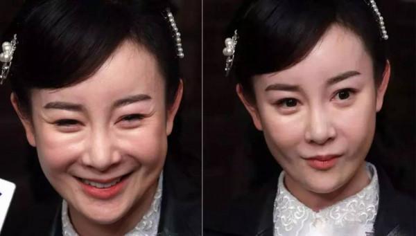 臉腫，嘴歪，笑不出來，整容後的&quot&semi;矽膠臉&quot&semi;把這9位好演員，害慘了