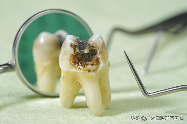 不痛不用拔?這些殘根危害可不小,嚴重要截骨 不痛不用拔?這些殘根危害可不小,嚴重要截骨