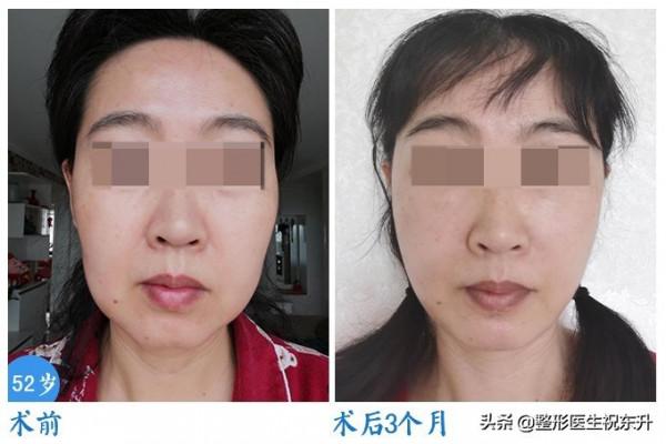 拉皮手術只能維持3、5年,恢復期還非常痛苦?醫生有話說 拉皮手術只能維持3、5年,恢復期還非常痛苦?醫生有話說