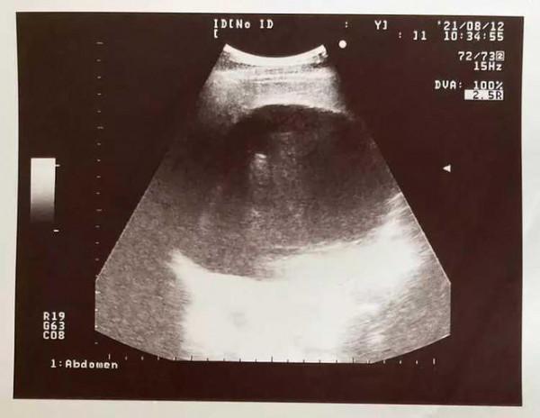 66歲藝人罹患肝癌&excl;體內隱匿14&period;5公斤巨型腫瘤，直言活1秒都是痛苦