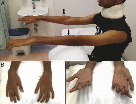 手部無力,上肢萎縮,手掌呈爪狀?醫生提醒:警惕“平山病” 手部無力,上肢萎縮,手掌呈爪狀?醫生提醒:警惕“平山病”