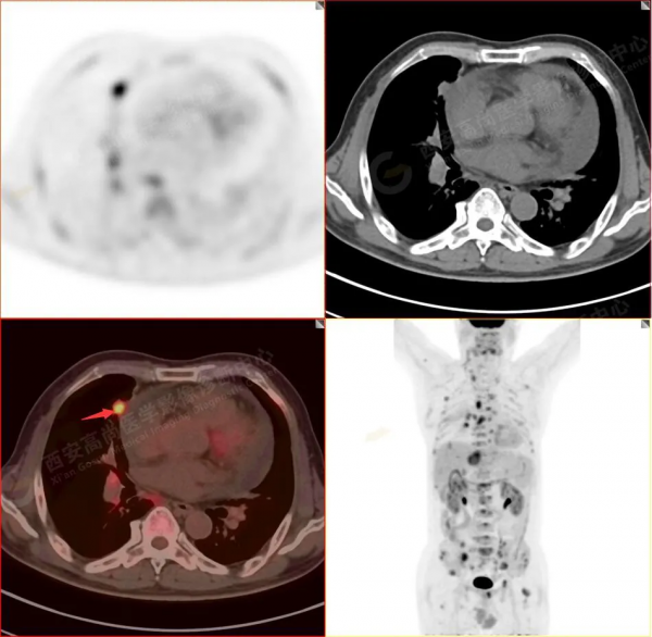 肺結節看診（13）：肺小結節全身廣泛轉移2例，PET分期：晚期