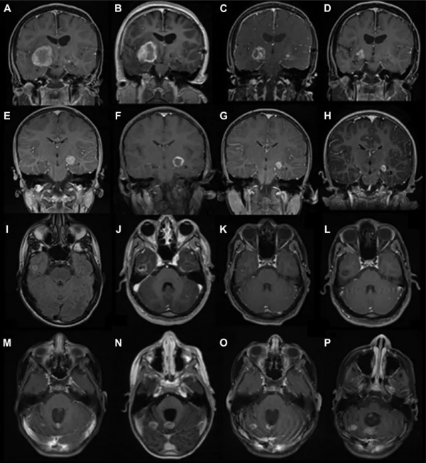 不用開顱的LITT鐳射間質熱療，治腦瘤真的有效嗎？最新臨床資料