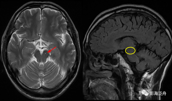 VR腔隙、腔梗灶、微出血、脫髓鞘，傻傻分不清？快看這裡