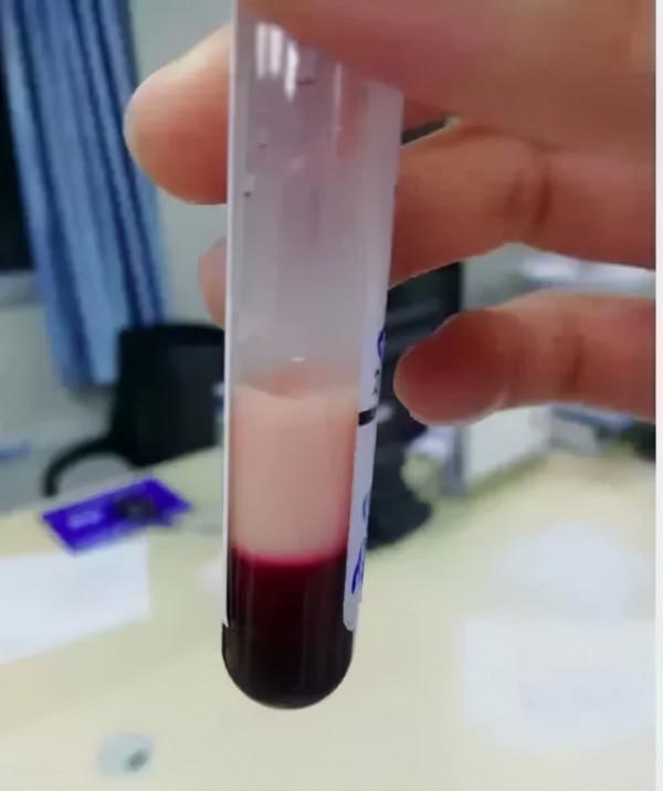 孕婦體重130斤！9&period;5斤&OpenCurlyDoubleQuote;巨大兒&rdquo;高血壓、皮質醇增多症接踵而至