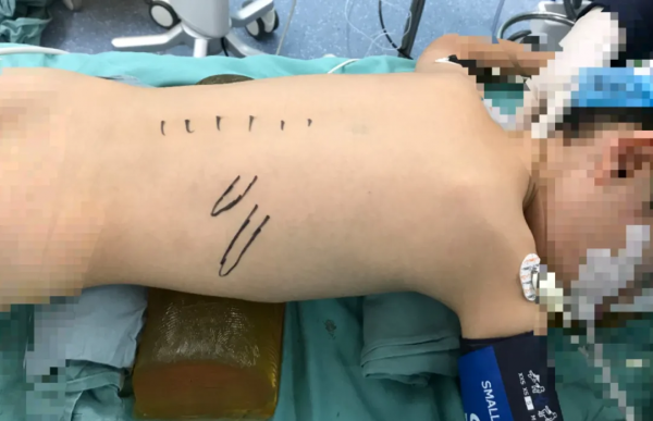 鍾量 | 兒童腎結石F4.8針式腎鏡PCNL碎石術