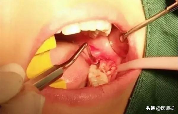 智齒為何總是成年出現?科學家給出結論,下巴空間有限 智齒為何總是成年出現?科學家給出結論,下巴空間有限