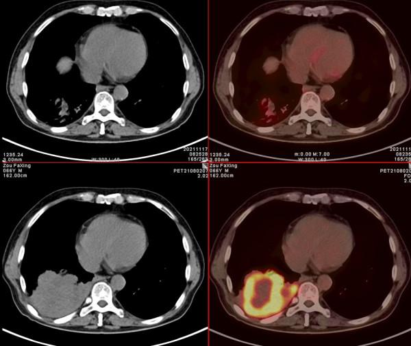 PET/CT病例（1）：晚期肺癌治療3個月，老人重現希望和曙光