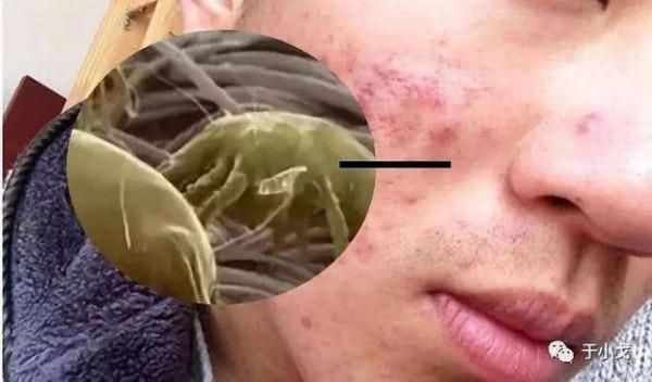 怎麼老是長痘，到底是為什麼呢