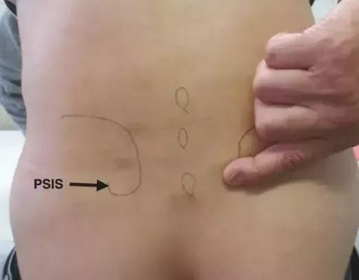 容易被誤診的“腰痛”——骶髂關節炎