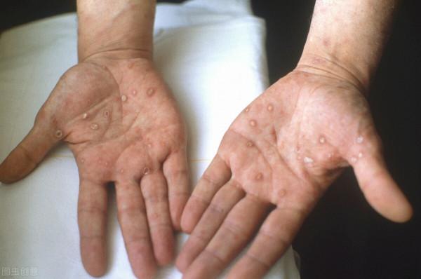 注意！這不是海鮮過敏，是二期梅毒