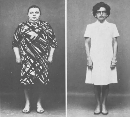 只吃大米和白糖，瘦了100多斤？關於&OpenCurlyDoubleQuote;碳化症&rdquo;的一些思考