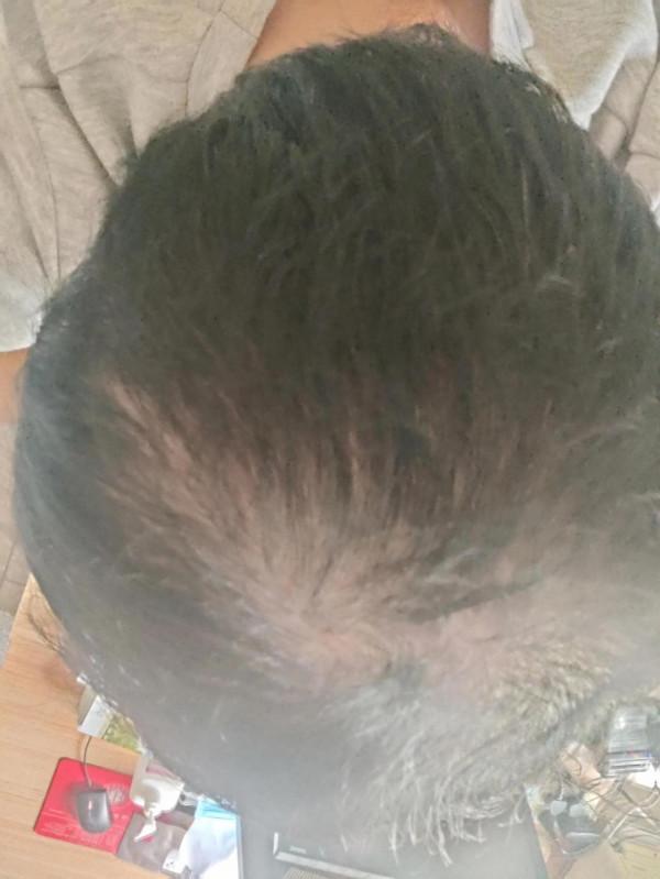 中醫對待脫髮的辦法 中醫對待脫髮的辦法