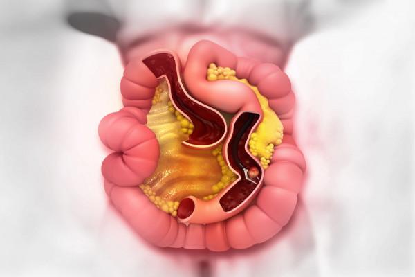 Nature：結直腸癌發病年輕化，篩查難題如何解？