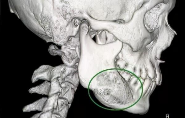 下頜角手術可以只做一側嗎? 下頜角手術可以只做一側嗎?