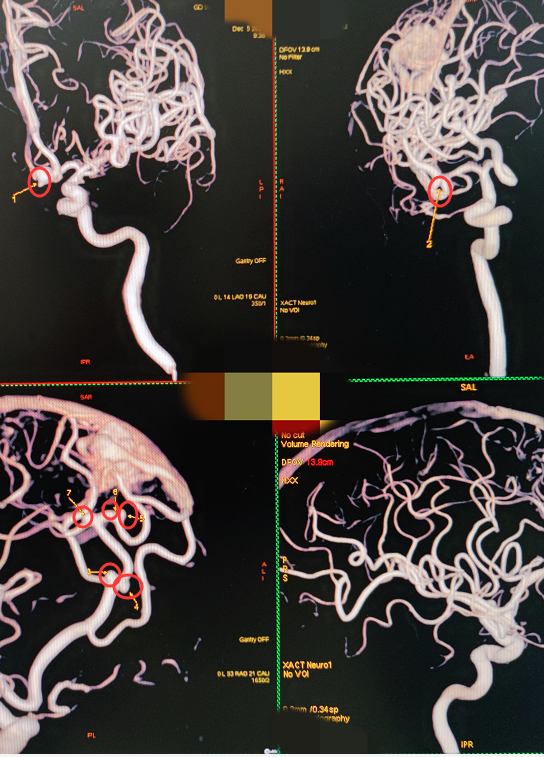 天冷洗個熱水澡，差點誘發腦內7個“不定時炸彈”