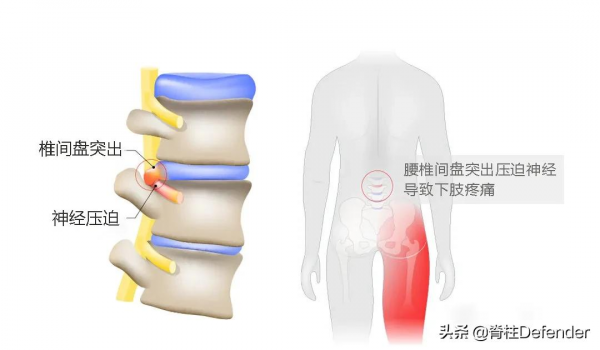 實錄｜我的腰椎間盤突出