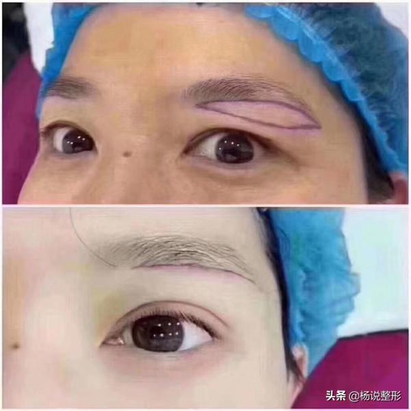 切眉術後護理決定了切眉的效果,這10點一定要注意,建議收藏 切眉術後護理決定了切眉的效果,這10點一定要注意,建議收藏