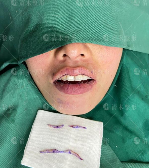 m唇+上下唇改型 m唇+上下唇改型