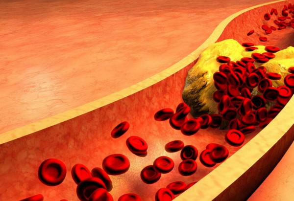 國產降壓藥阿利沙坦酯，保護心腎還可以降尿酸，幾乎不影響肝腎