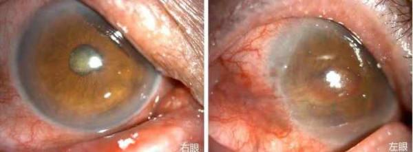 55歲大伯雙眼先後逐漸失明，這種&OpenCurlyDoubleQuote;羈絆&rdquo;最長潛伏期可達十幾年